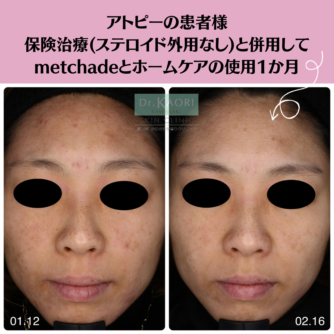 オリジナルサプリmetchadeをお試しの患者様からうれしい報告